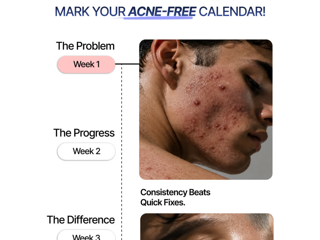 Anti Acne Soap with 2% Salicylic Acid | 75g Pack of 2, feature 4 of 6